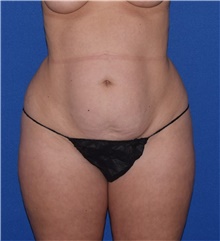 Tummy Tuck Before Photo by Karol Gutowski, MD, FACS; Glenview, IL - Case 39132