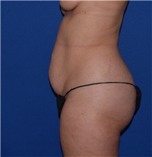 Tummy Tuck Before Photo by Karol Gutowski, MD, FACS; Glenview, IL - Case 39132