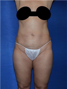 Liposuction After Photo by Karol Gutowski, MD, FACS; Glenview, IL - Case 39159