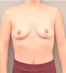 Breast Lift After Photo by Keshav Magge, MD; Bethesda, MD - Case 39186