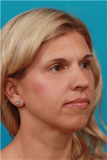 Eyelid Surgery After Photo by Michael Bogdan, MD, MBA, FACS; Grapevine, TX - Case 39206
