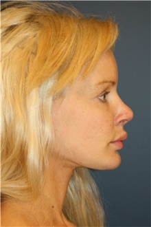 Rhinoplasty After Photo by Steve Laverson, MD, FACS; Rancho Santa Fe, CA - Case 39346