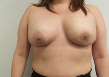 Breast Reconstruction After Photo by C. Andrew Salzberg, MD; Vero Beach, FL - Case 39379