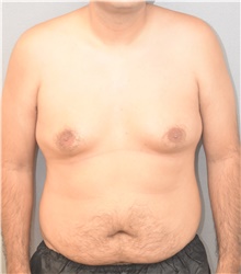 Male Breast Reduction Before Photo by Keshav Magge, MD; Bethesda, MD - Case 39543