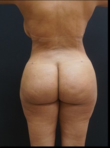 Buttock Lift with Augmentation After Photo by Johnny Franco, MD; ,  - Case 39927