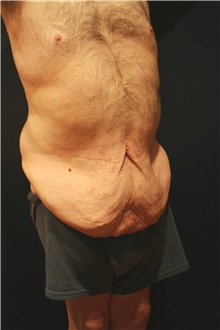 Body Lift Before Photo by Larry Weinstein, MD; Chester, NJ - Case 39957