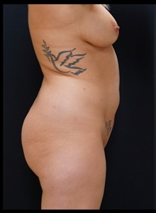 Buttock Lift with Augmentation Before Photo by Johnny Franco, MD; ,  - Case 39960