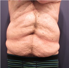 Body Lift Before Photo by Michele Shermak, MD; ,  - Case 39971
