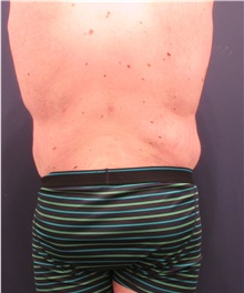 Body Lift After Photo by Michele Shermak, MD; ,  - Case 39971