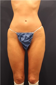 Thigh Lift Before Photo by Michele Shermak, MD; ,  - Case 39975