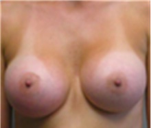 Breast Augmentation After Photo by Mariam Awada, MD, FACS; ,  - Case 40136
