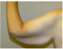 Arm Lift Before Photo by Mariam Awada, MD, FACS; ,  - Case 40201