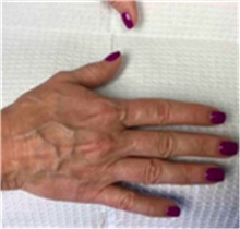 Dermal Fillers Before Photo by Mariam Awada, MD, FACS; ,  - Case 40260