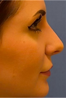 Dermal Fillers After Photo by Mariam Awada, MD, FACS; ,  - Case 40262
