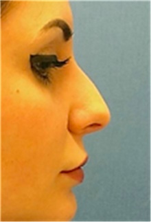 Dermal Fillers Before Photo by Mariam Awada, MD, FACS; ,  - Case 40262
