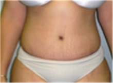 Tummy Tuck After Photo by Mariam Awada, MD, FACS; ,  - Case 40312