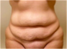Tummy Tuck Before Photo by Mariam Awada, MD, FACS; ,  - Case 40312