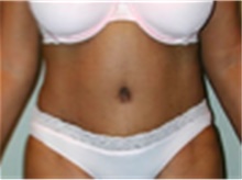 Tummy Tuck After Photo by Mariam Awada, MD, FACS; ,  - Case 40313