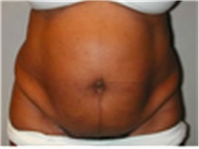 Tummy Tuck Before Photo by Mariam Awada, MD, FACS; ,  - Case 40313