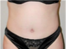 Tummy Tuck After Photo by Mariam Awada, MD, FACS; ,  - Case 40330