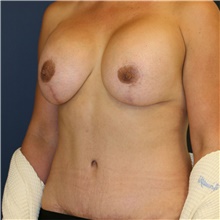 Mommy Makeover After Photo by Steve Laverson, MD, FACS; Rancho Santa Fe, CA - Case 40671
