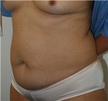 Tummy Tuck Before Photo by Steve Laverson, MD, FACS; Rancho Santa Fe, CA - Case 40831