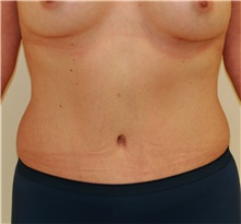 Tummy Tuck After Photo by Steve Laverson, MD, FACS; Rancho Santa Fe, CA - Case 40831