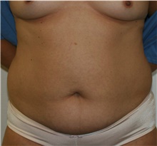 Tummy Tuck Before Photo by Steve Laverson, MD, FACS; Rancho Santa Fe, CA - Case 40831
