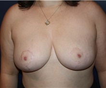 Breast Reduction After Photo by Larry Weinstein, MD; Chester, NJ - Case 40903