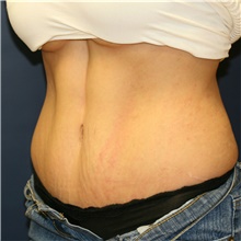 Tummy Tuck After Photo by Steve Laverson, MD, FACS; Rancho Santa Fe, CA - Case 41096