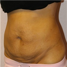 Tummy Tuck Before Photo by Steve Laverson, MD, FACS; Rancho Santa Fe, CA - Case 41096