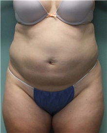 Liposuction Before Photo by Jennifer Greer, MD; Mentor, OH - Case 41102