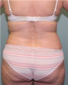 Liposuction After Photo by Jennifer Greer, MD; Mentor, OH - Case 41102
