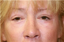 Eyelid Surgery After Photo by Steve Laverson, MD, FACS; Rancho Santa Fe, CA - Case 41210