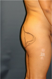 Buttock Lift with Augmentation Before Photo by Steve Laverson, MD, FACS; Rancho Santa Fe, CA - Case 41351