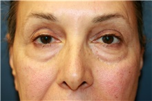 Eyelid Surgery Before Photo by Steve Laverson, MD, FACS; Rancho Santa Fe, CA - Case 41464