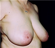 Breast Reduction Before Photo by Steve Laverson, MD, FACS; Rancho Santa Fe, CA - Case 41479