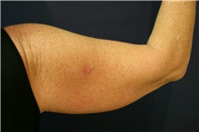 Arm Lift Before Photo by Steve Laverson, MD, FACS; Rancho Santa Fe, CA - Case 41516