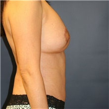 Mommy Makeover After Photo by Steve Laverson, MD, FACS; Rancho Santa Fe, CA - Case 41593