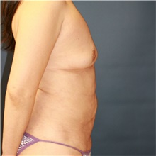 Mommy Makeover Before Photo by Steve Laverson, MD, FACS; Rancho Santa Fe, CA - Case 41593