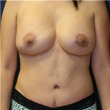 Mommy Makeover After Photo by Steve Laverson, MD, FACS; Rancho Santa Fe, CA - Case 41593