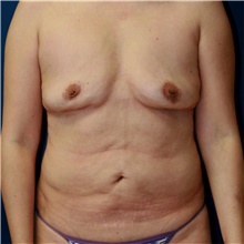 Mommy Makeover Before Photo by Steve Laverson, MD, FACS; Rancho Santa Fe, CA - Case 41593