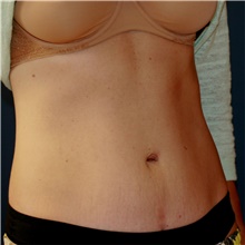 Tummy Tuck After Photo by Steve Laverson, MD, FACS; Rancho Santa Fe, CA - Case 41646