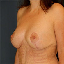 Breast Lift After Photo by Steve Laverson, MD, FACS; Rancho Santa Fe, CA - Case 41664