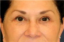 Eyelid Surgery After Photo by Steve Laverson, MD, FACS; Rancho Santa Fe, CA - Case 41691