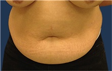 Tummy Tuck Before Photo by Jerry Weiger Chang, MD, FACS; Flushing, NY - Case 41880