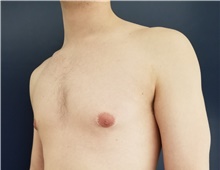 Male Breast Reduction Before Photo by Noel Natoli, MD, FACS; East Hills, NY - Case 41908