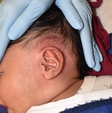 Ear Surgery After Photo by Rachel Ruotolo, MD; Garden City, NY - Case 42048