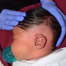 Ear Surgery Before Photo by Rachel Ruotolo, MD; Garden City, NY - Case 42048