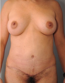 Mommy Makeover After Photo by Ellen Mahony, MD; Westport, CT - Case 42421